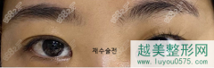 我在韩国grida医院做的埋线双眼皮好自然!已经5年了还没有松
