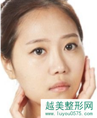 上海下颌角磨骨手术真实案例