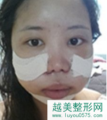 上海下颌角磨骨手术真实案例术后