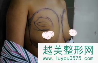 北京脂肪隆胸矫正胸部下垂缩水6个月案例