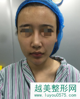 汉州面部衰老全脸脂肪移植填充案例