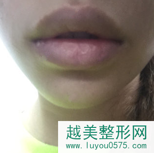 上海做厚唇改薄手术恢复3个月案例