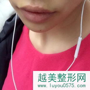 上海做厚唇改薄手术恢复术后案例