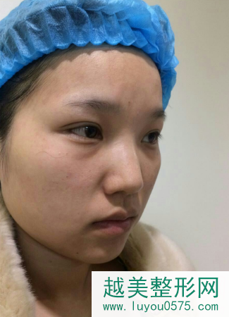 上海假体隆鼻加硅胶垫下巴术后案例