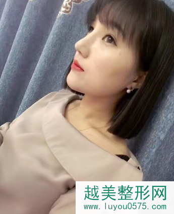 上海假体隆鼻加硅胶垫下巴术后恢复案例