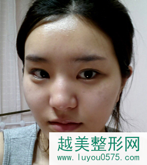 上海隆鼻+多方面部脂肪填充提升案例分享
