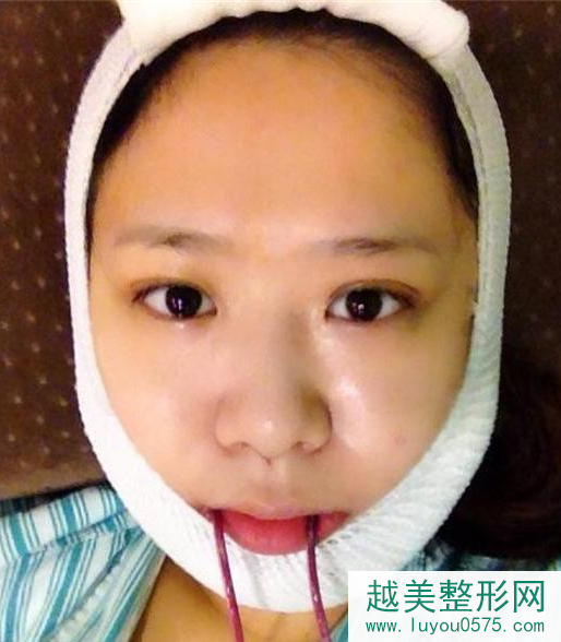上海小方脸下颌角磨骨手术恢复