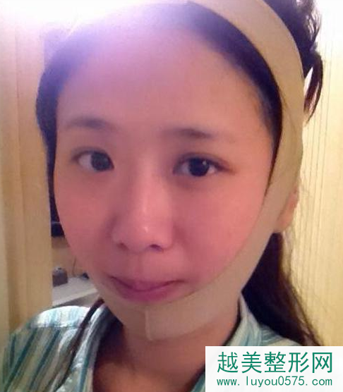 上海小方脸下颌角磨骨手术案例