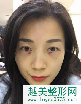 北京内切去眼袋术后案例
