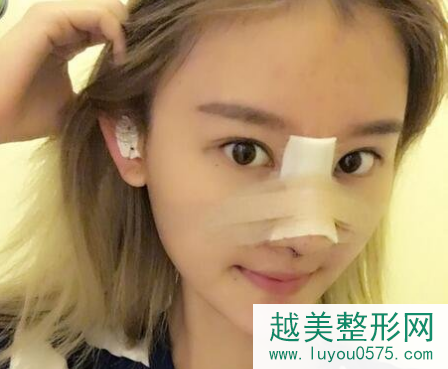 上海隆鼻加脂肪填充恢复案例