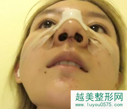 上海隆鼻加脂肪填充恢复