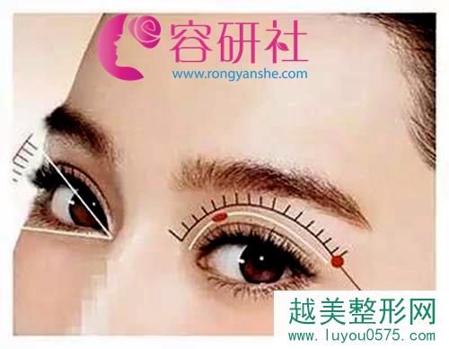 韩国清潭FIRST成镇模胎式微创眼修复专业解决双眼皮失败