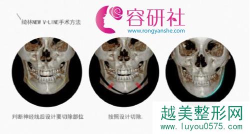 韩国绮林整形医院长曲线下颌角手术示意