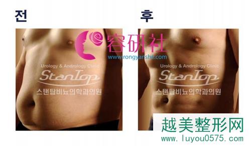 韩国世檀塔脂肪雕刻腹肌前后果对比