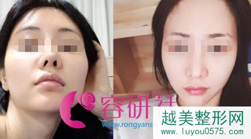 韩国美迪莹整形外科面部轮廓手术案例