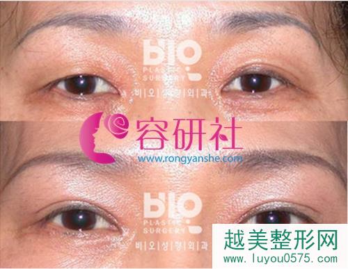 韩国bio整形外科眼部手术案例