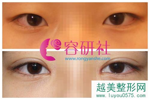 韩国ucanb整形医院双眼皮手术案例