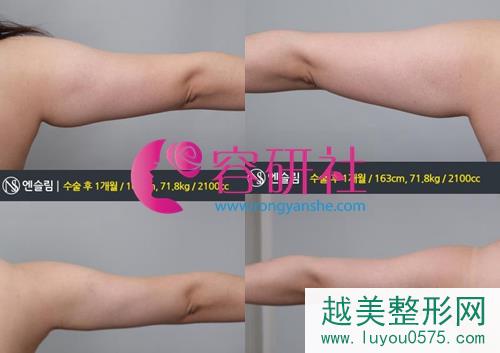 韩国安瑟琳吸脂中心手部吸脂案例