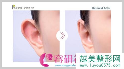 韩国profile（普露菲耳）整形外科小耳症矫正案例
