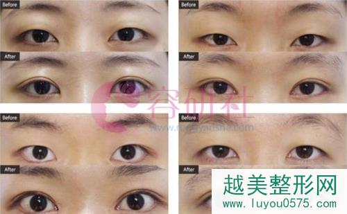 韩国ST整形外科双眼皮手术案例