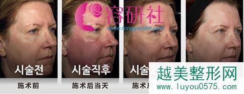 韩国Tam皮肤科双飞梭镭射术前术后对比