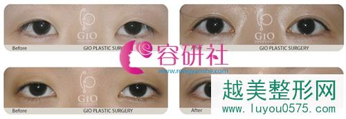 韩国gio整形医院双眼皮消失修复案例