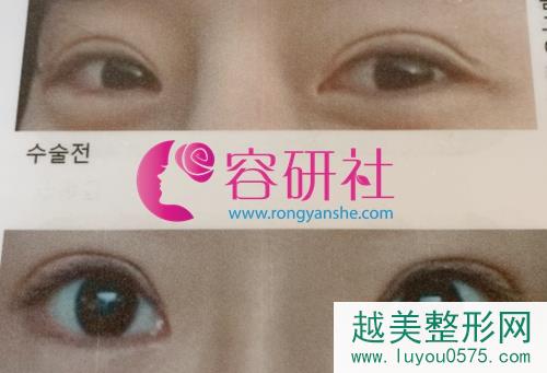 韩国GIO整形外科开眼角手术案例