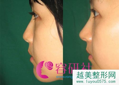 韩国可安美整形鼻部手术案例