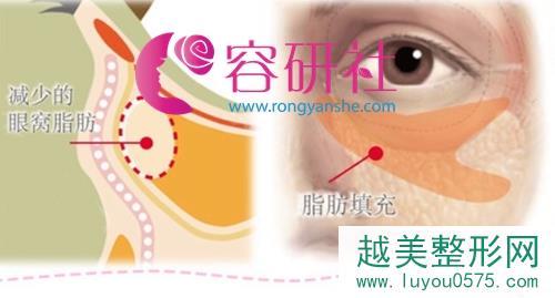 日本银座美幸美容外科祛黑眼圈眼袋方法
