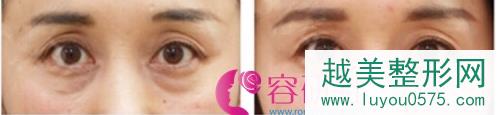 日本银座美幸美容外科祛黑眼圈眼袋案例对比图