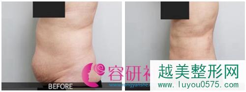 韩国安瑟琳医院杨东允院长腹部吸脂案例对比图