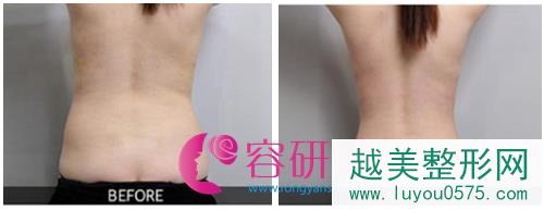 韩国安瑟琳医院杨东允院长腰部吸脂案例对比图
