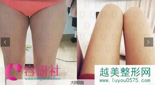 韩国dreamline吸脂塑形医院大腿吸脂案例对比图