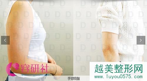 韩国dreamline吸脂塑形医院手臂吸脂案例对比图