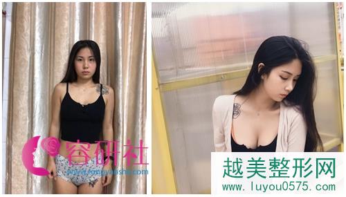 韩国普露菲耳（profile）整形医院魔笛假体隆胸案例对比图