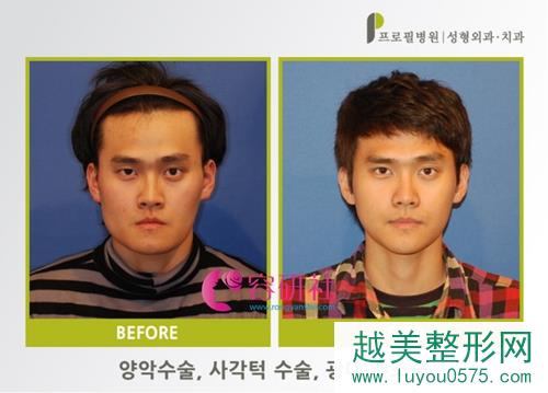 韩国普露菲耳profile整形医院面部轮廓手术案例