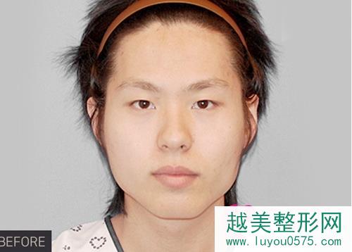 韩国普露菲耳profile整形医院长曲线下颌角手术前