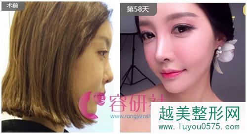韩国普露菲耳proflie整形医院鼻部手术案例对比图