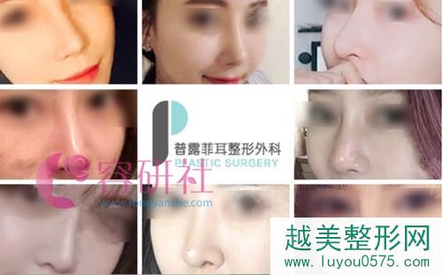 韩国普露菲耳proflie整形医院鼻部手术案例