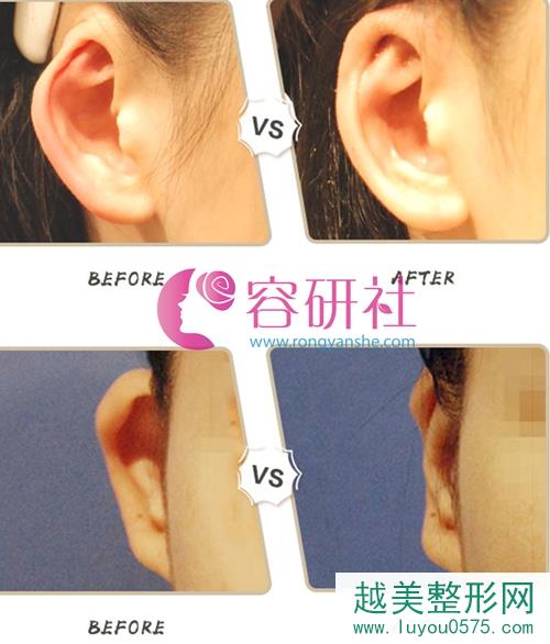 韩国普露菲耳proflie整形医院小耳畸形案例对比图