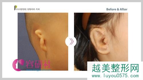 韩国普露菲耳proflie整形医院小耳畸形案例对比图