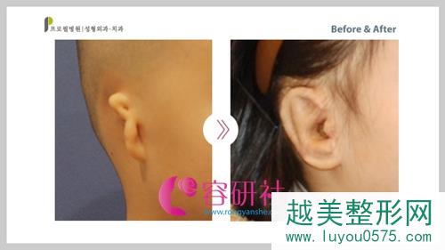韩国普露菲耳profile整形医院耳畸形矫正案例