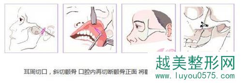韩国普罗菲耳proflie整形医院颧骨颧弓整形术切口方式