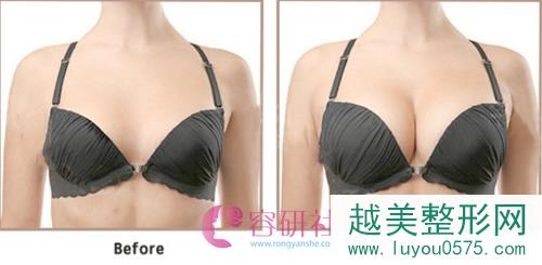 韩国普罗菲耳profile整形医院蓓菈假体隆胸案例对比图