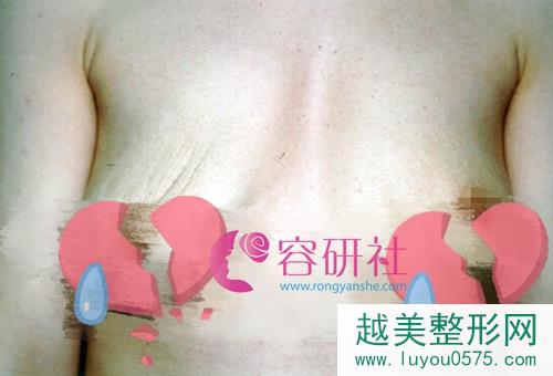 韩国普罗菲耳profile整形医院取出假体后的胸部