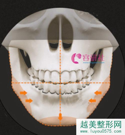韩国profile普罗菲耳整形医院面部轮廓