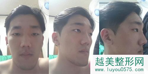 韩国profile普罗菲耳整形医院面部轮廓术前