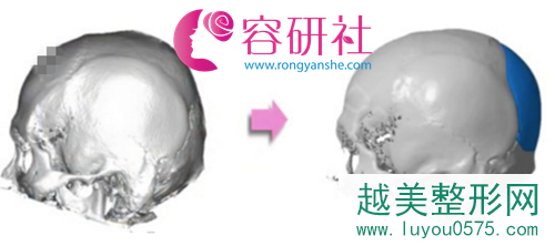 韩国雕刻医院骨水泥填充后脑勺术前扫描
