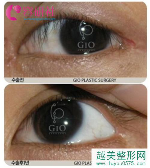 韩国gio医院眼睛修复案例