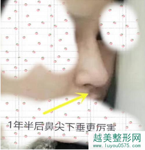 韩国普罗菲耳医院针对鼻尖下垂的解决办法